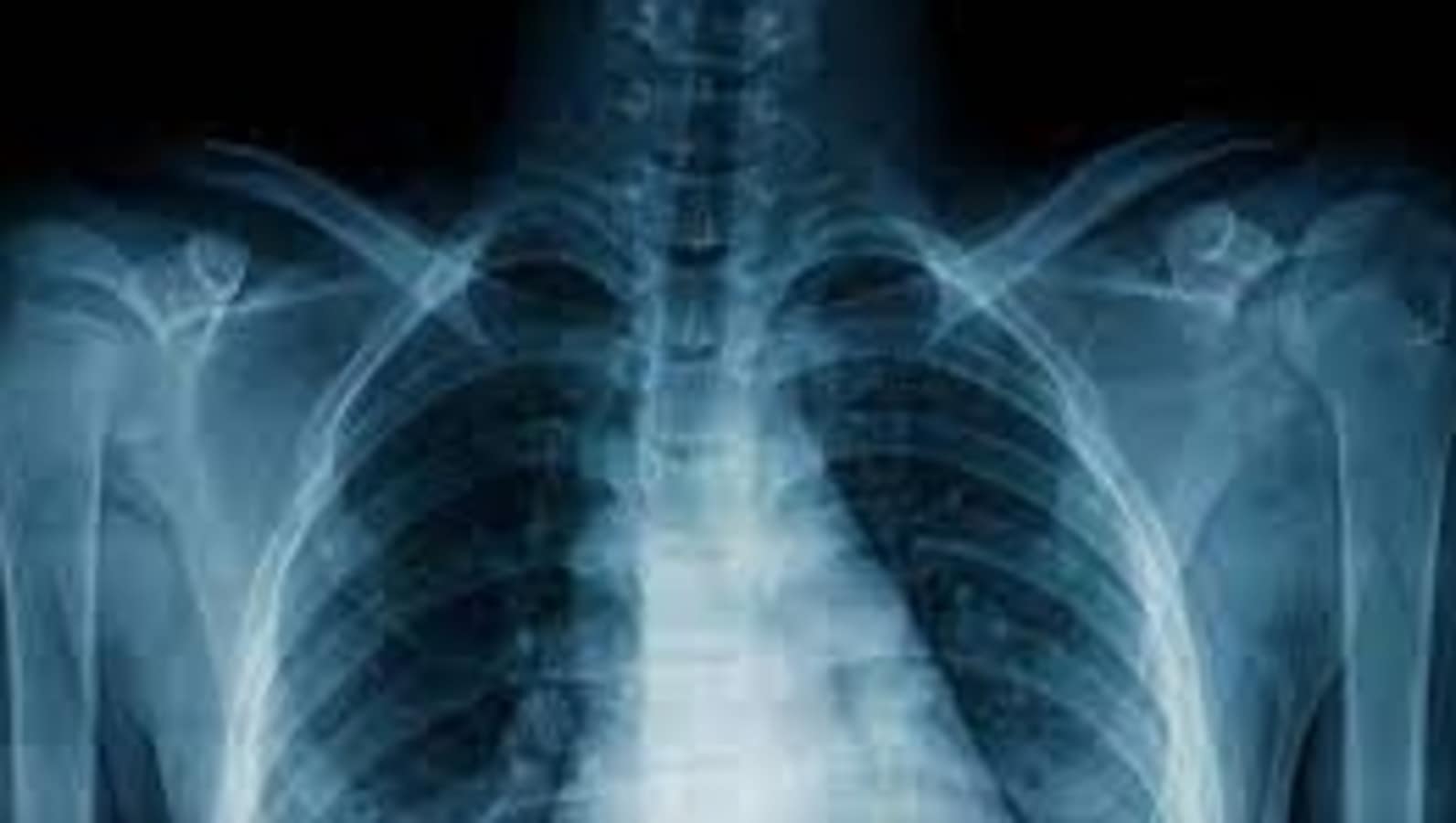 World Tuberculosis (TB) Day 2024: Date, history, theme and significance