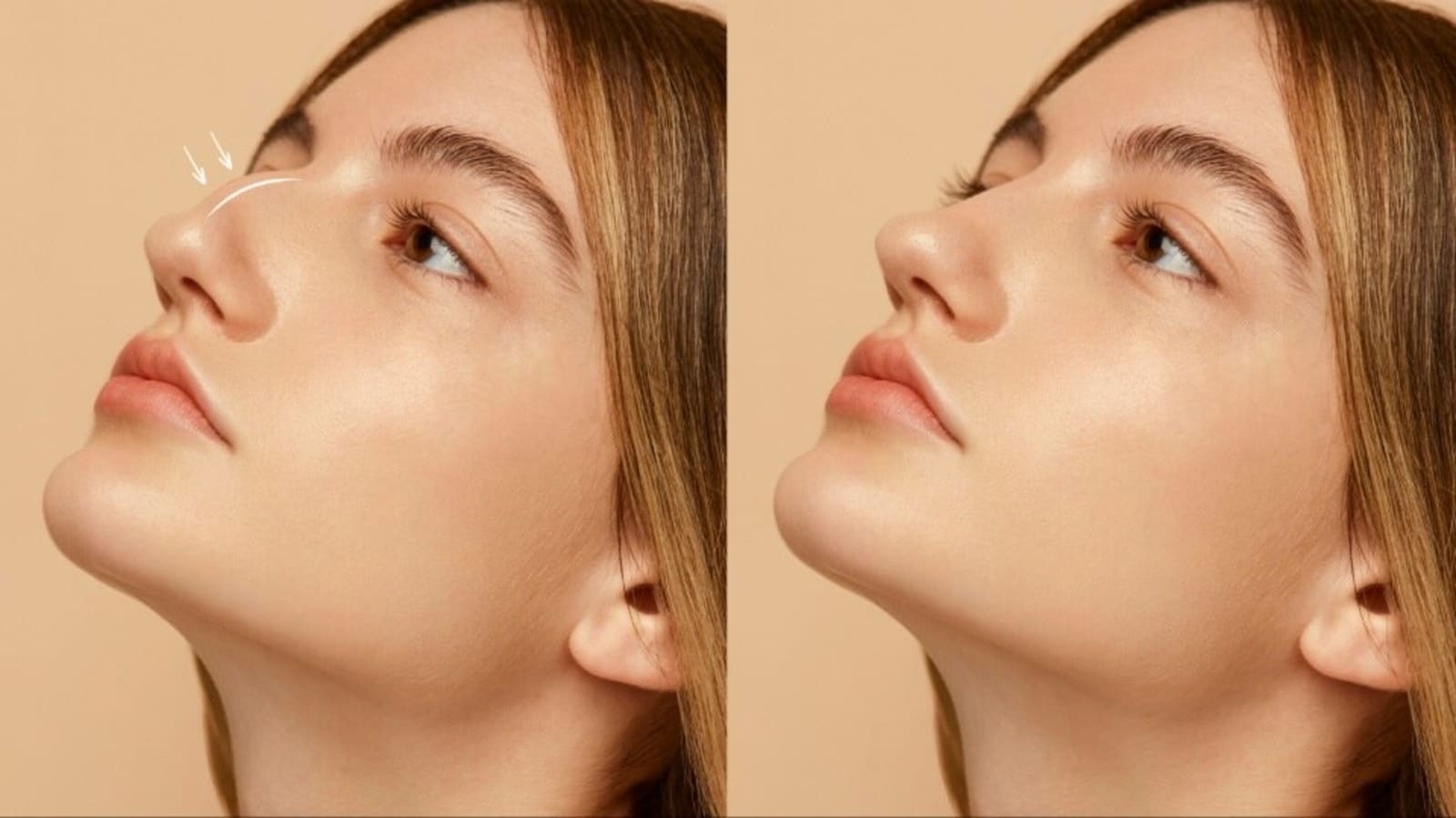 Want to achieve harmonious facial contours? Know all about non-surgical rhinoplasty or nose job